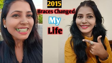 Braces Changed My Life 😊  | Teeth Braces Before And After | Nd Family Vlogs