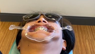 First Braces Adjustment in 2025 | Beach Time #Bellamyorthodontics #braces  #vancouverisland #beach