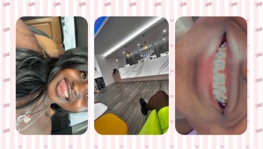 Braces removal #explore