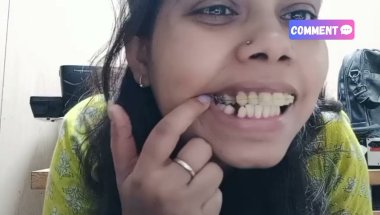 2 week complete with braces 😬#braces #dentalbraces #bracestreatment