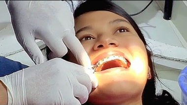 দাঁতের Braces ট্রিটমেন্ট – খরচ, ব্যথা, সময় ও আমার Real Experience| Dat er Brace Treatment