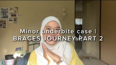 Minor underbite case | Braces journey PART 2