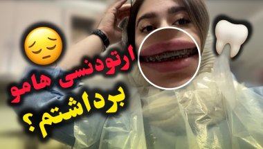 ارتودنسی هامو برداشتم؟ یا نه؟ 🫠