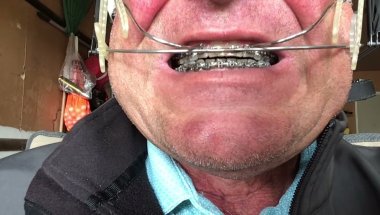 Headgear and braces