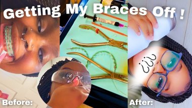 Vlog: GETTING MY BRACES OFF| in love with my results!?| It HURT??| permanent retainer?|my experience