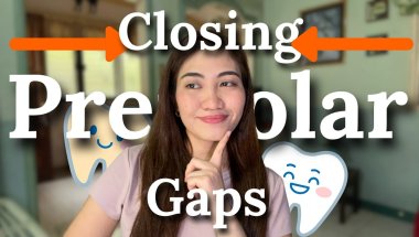 June Braces Updates || Closing Premolar Gaps