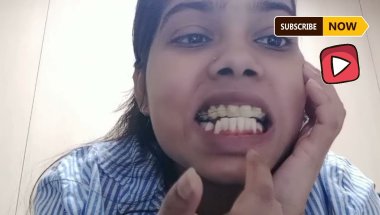 Day21 braces - आखिर क्यों हुआ अचानक दर्द?#braces#bracestreatment #bracestips