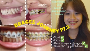 Why you should NOT go for BRACES 🥲