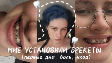 мне поставили брекеты | первые дни | уход и ощущения | брекеты моя история