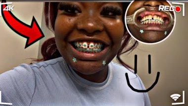 Come with me to get braces #braces