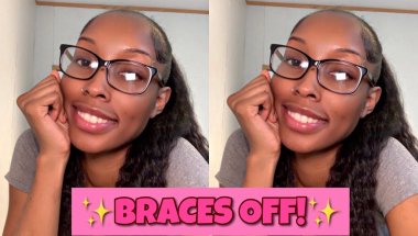 Braces OFF! My Teeth Transformation + Retainers, Shaping & Polishing