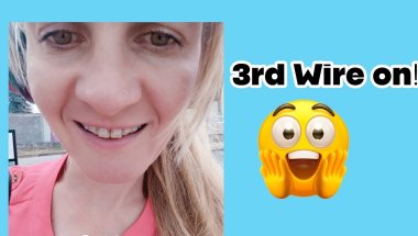 Already the 3rd month IN!😁#braces #teeth #dentalbraces #orthodontics