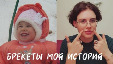 брекеты моя история | как всё началось