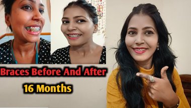 Teeth Braces Before And After | Braces Before And After | Nd Family Vlogs