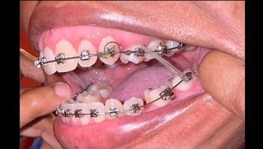 THIS IS HOW I PUT MY CURRENT RUBBER BANDS