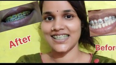 6 month ka new update Gap all closed 😱 #youtube #vlog #braces #update rupag25