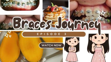 Braces Series (Episode 3): Before and After changes in 2 months.