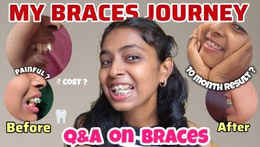 🦷😨 My Braces Journey || Cost, types of Braces, Pain 2025 | Q&A with real experience 10 Month Result