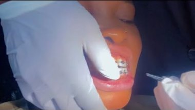 2nd month to change my braces #braces #viralvideo #fypシ゚viral #longvideo #youtube