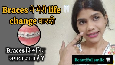 My braces journey ✨🦷| braces update #motivation