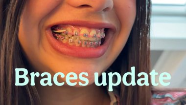 MY BRACES GAPS ARE FINALLY CLOSED! 😱 Vlog #8