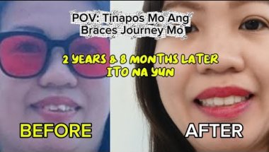 My Complete Braces Journey | Before Braces to Braces Off + First Meal & Retainer Day