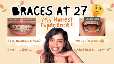 Adult Braces : My Honest 3-Month Experience😬IPR or Extraction, Type of Braces, Duration, Cost & More
