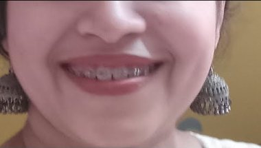 Braces review..