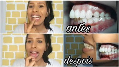 aparelho ortodôntico antes e depois |Coloquei aparelho Móvel, vou usar por 2 anos