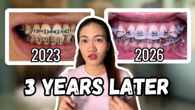 Did I Regret My Premolar Extractions? Things I Learned | 3 Year Update