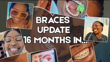 This is What 16 Months of Braces Did to My Teeth 😳