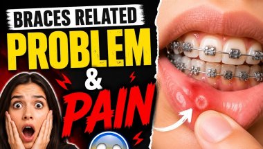 Braces lagwane se pahle jan lo ye baate//Braces related problems and pain//#yt  #trending #minivlog