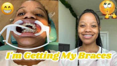 I GOT BRACES & PALATE EXPANDER! | DOUBLE TAKE