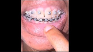 This Is Why You Should Go to Dentist To Clean Teeth