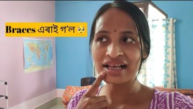 Day-9/200 challenge/দাতঁৰ Braces এৰাই গ'ল 🥺