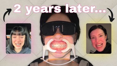 I FINALLY GOT MY BRACES TAKEN OFF