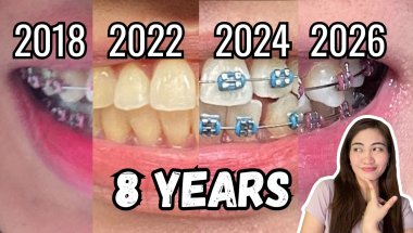 I Spent 8 years with Braces... Here are 8 things you need to know