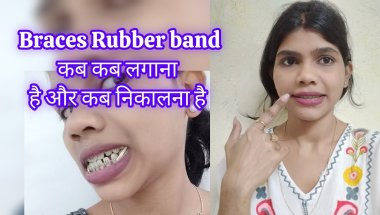 Braces Rubber band कब लगाना है और कब निकालना चाहिए🦷✨| braces vlog #braces #bracesjourney