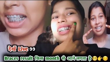 Braces result kab deta hai🦷👉😬😵|| dekhen live👀 #dentalbraces #dentaltreatment #teethextraction