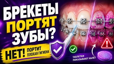 Брекеты портят зубы?