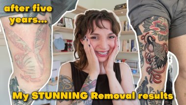 My Tattoo Removal Journey is Finally Over