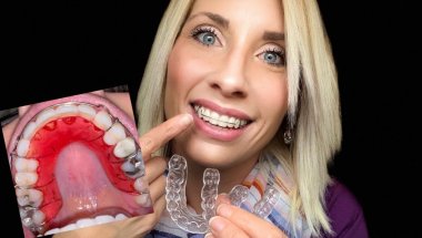 “POST BRACES” | 3 Month’s - Reaction to Hawley Retainer!