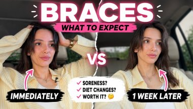 BRACES | immediately vs a week later 🦷 | SANDRA BUICA