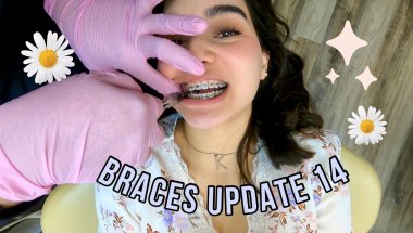 Braces Update 14 🦷 (One year & two months with braces + molar engagement)