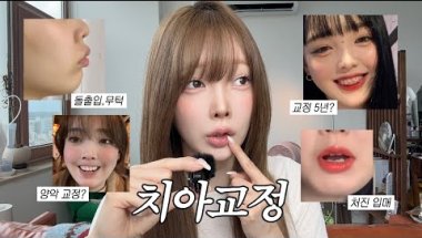 🦷교정 했더니 윤곽할 돈 아낌... | 돌출입 • 무턱 • 양악 교정 / 악궁확장장치 / 치아교정만 5년 😬