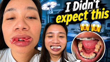 I DID NOT EXPECT THIS TOO EARLY! TWO PRE MOLAR EXTRACTION TO CORRECT MY UNDERBITE PROBLEM!