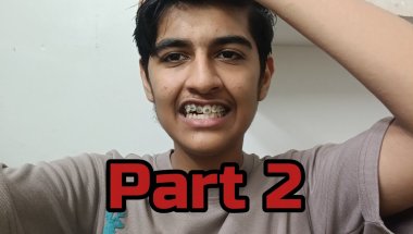 Braces review after 2 appointment