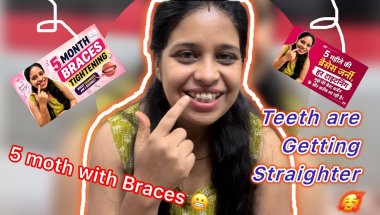 5 months of braces and finally seeing visible changes! 🦷✨#braces progress#braceslife