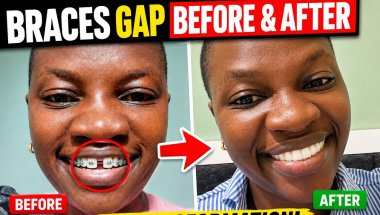 Safari Yangu na braces  Kabla na Baada ya braces  Kwanini niliweka |part one