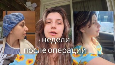 Восстановление после операции по изменению дистального прикуса